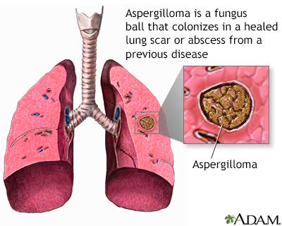 Aspergillosis Disease: Symptoms and Treatments - w3buzz