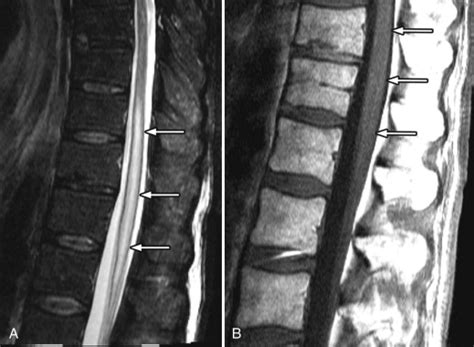 Spinal Cord Infarction And Differential Diagnosis Rad - vrogue.co