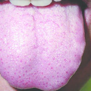 (PDF) Transient lingual papillitis: A retrospective study of 11 cases and review of the literature