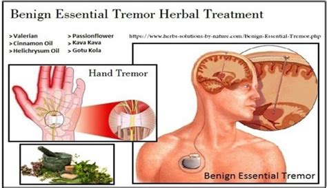 Benign Essential Tremor Treatment at Parijatak - Upstart