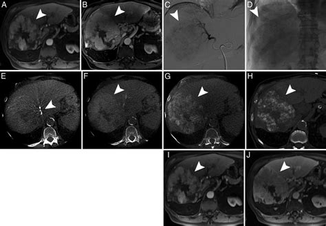 Example of a conventional TACE procedure that highlights the same steps... | Download Scientific ...