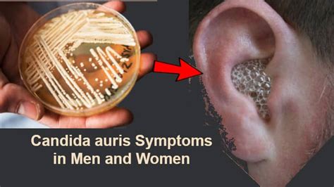 Candida auris Symptoms in Men and Women should never be ignored!