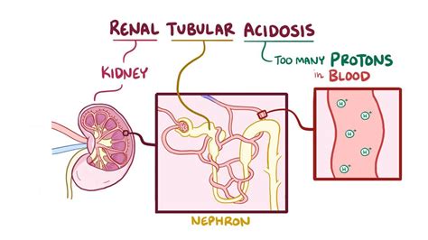 Renal tubular acidosis: Video, Anatomy & Definition | Osmosis