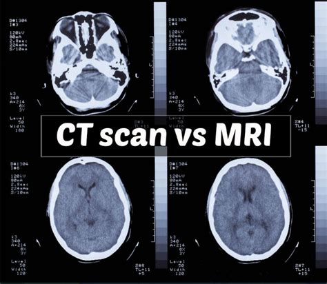 Comparing MRI and CT Scans in Personal Injury Cases - Precise Imaging