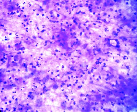 Cytopathological Pattern of Tubercular Lymphadenopathy on FNAC: Analysis of 550 Consecutive ...