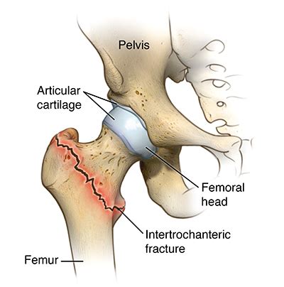 Hip Fracture | Cedars-Sinai