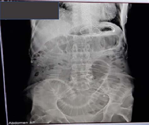 Plain abdominal X-ray showing dilated small bowel loops with visible... | Download Scientific ...