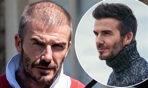 is david beckham norwood 5? - Open Hair Loss Topics - Hair Restoration ...