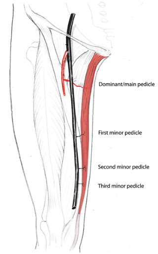 The Gracilis Myocutaneous Free Flap: A Quantitative Analysis of the ...