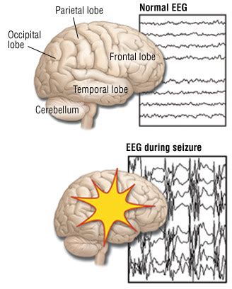 Partial Seizures (Focal Seizures) - Harvard Health