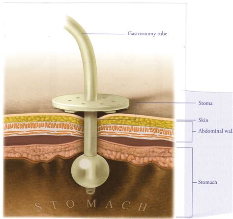 Gastrostomy Week - Devices