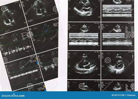 Heart Ultrasound Scan Examination. Echo Cardiography Examine for Stock Photo - Image of beats ...