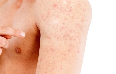 Causes of heat rash | Heat Hives: Symptoms, Treatment, and Prevention. 2020-06-19