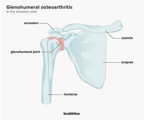 Glenohumeral (Shoulder) Osteoarthritis: Causes, Symptoms, Treatment