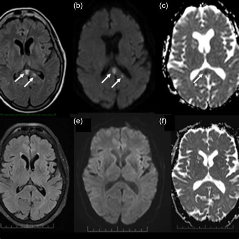 MRI brain on presentation demonstrating FLAIR hyperintensities (arrows)... | Download Scientific ...