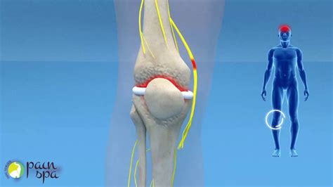 Genicular Nerve Block and Ablation, Metode Baru Atasi Nyeri Lutut Kronis