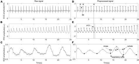 Frontiers | A study on the immediate effects of enhanced external counterpulsation on ...