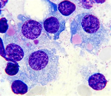 Plasma cells with cytoplasmic inclusions