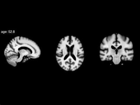 Aging brain MRI - YouTube