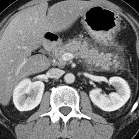 Acute Pancreatitis and Complications | Radiology Key