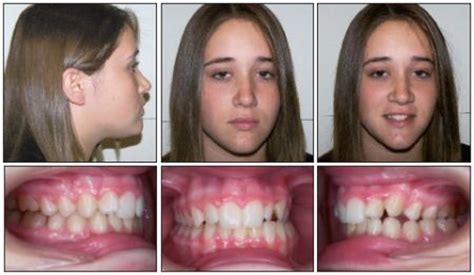 How To Fix A Crossbite In Adults : What is the best treatment method for Anterior Crossbites ...