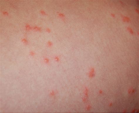 scabies bite picture - pictures, photos