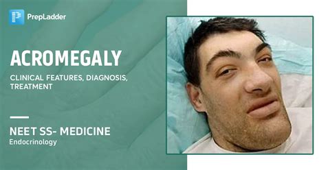 Acromegaly- Clinical Features, Diagnosis, Treatment