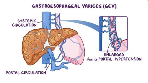 Gastroesophageal varices: Clinical sciences - Osmosis Video Library