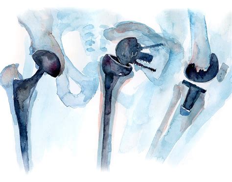 Orthopedics Watercolor Print Orthopedic Surgery Art - Etsy