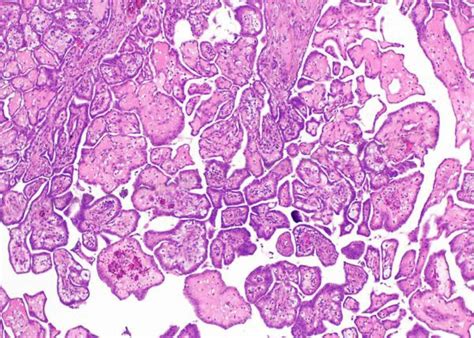 Papillary Mesothelioma | Diagnosis, Treatment & Prognosis