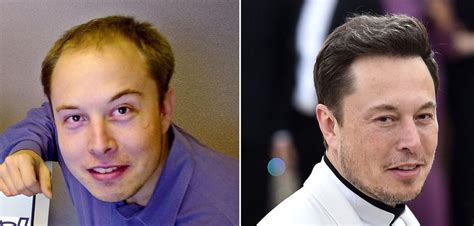 Celebrities with Hair Transplant: Elon Musk and David Silva - RepHair