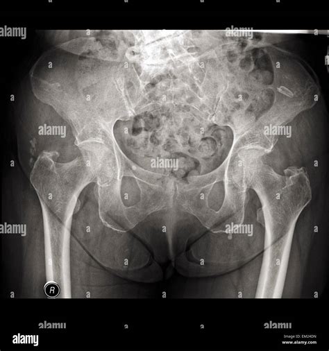 X-RAY image of elderly female pelvis with osteoporosis Stock Photo - Alamy