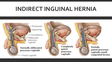 Inguinal hernia