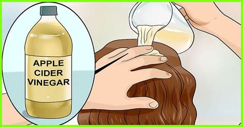 12 Home Remedies For Managing Scalp Psoriasis Effectively