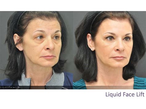 Liquid Face Lift I performed - Before & After pics | Facelift, Liquid facelift, Face