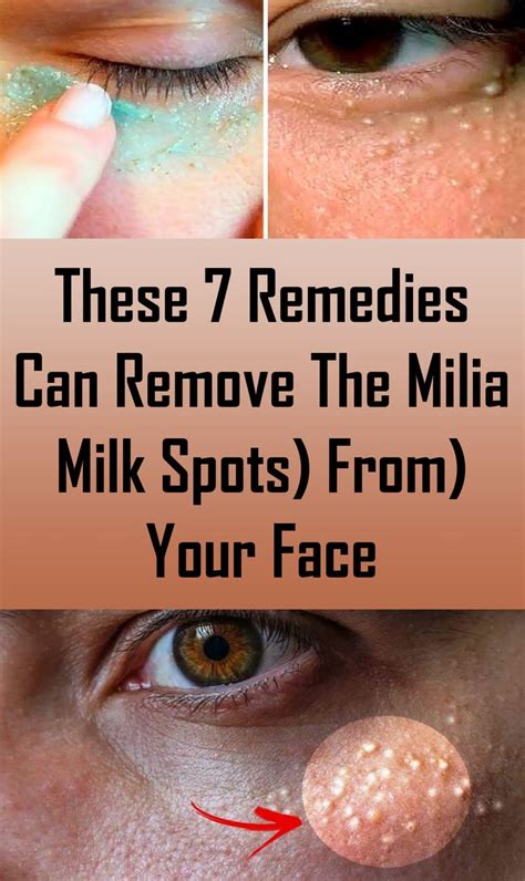 These 7 Remedies Can Remove The Milia (Milk Spots) From Your Face | Healthy skin tips, Natural ...