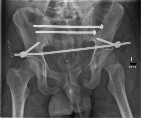 The use of anterior subcutaneous internal fixation (INFIX) for treatment of pelvic ring injuries ...