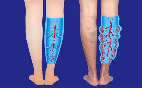 Leg Swelling: Lymphedema or Chronic Venous Insufficiency?