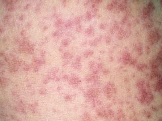 How is Scalded Skin Syndrome Treated? | Skin conditions