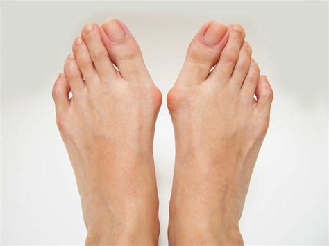 Bunions: Causes, Prevention, Symptoms, Treatment | Foot And Ankle