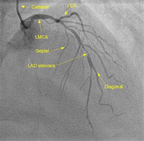 Left coronary angiogram showing stenosis of left anterior descending artery