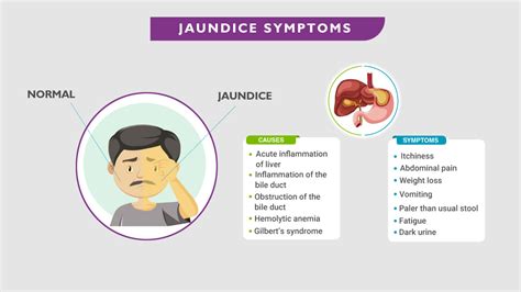 Jaundice-Causes, Symptoms & Treatment – NutritionFact.in