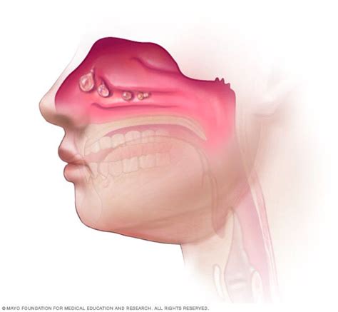 Nasal polyps Disease Reference Guide - Drugs.com