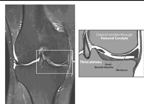 Hemi-bucket-handle tears of the meniscus: appearance on MRI and potential surgical implications ...