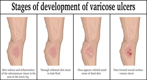 Avoiding Recurring Leg Ulcers | The Surgical Clinic