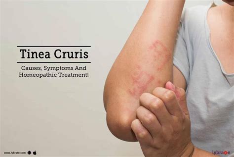 Tinea Cruris - Causes, Symptoms And Homeopathic Treatment! - By Dr. Sandeep Sarao | Lybrate