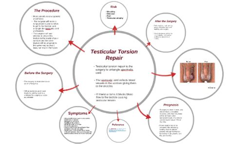 Testicular Torsion Procedure by Roberto Vasquez on Prezi