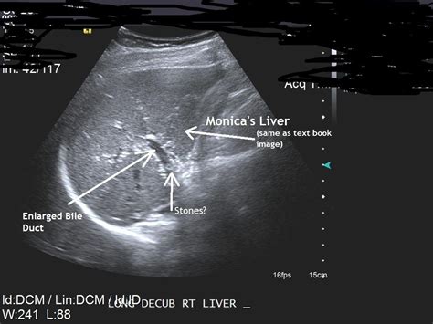 Doctor left stones in wifes liver , then claimed no stones, see image ...