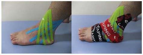 Short-Term Effect of Ankle Eversion Taping on Bilateral Acute Ankle Inversion Sprains in an ...