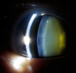 Oxygen near lens linked to cataracts in eye surgery patients - The ...